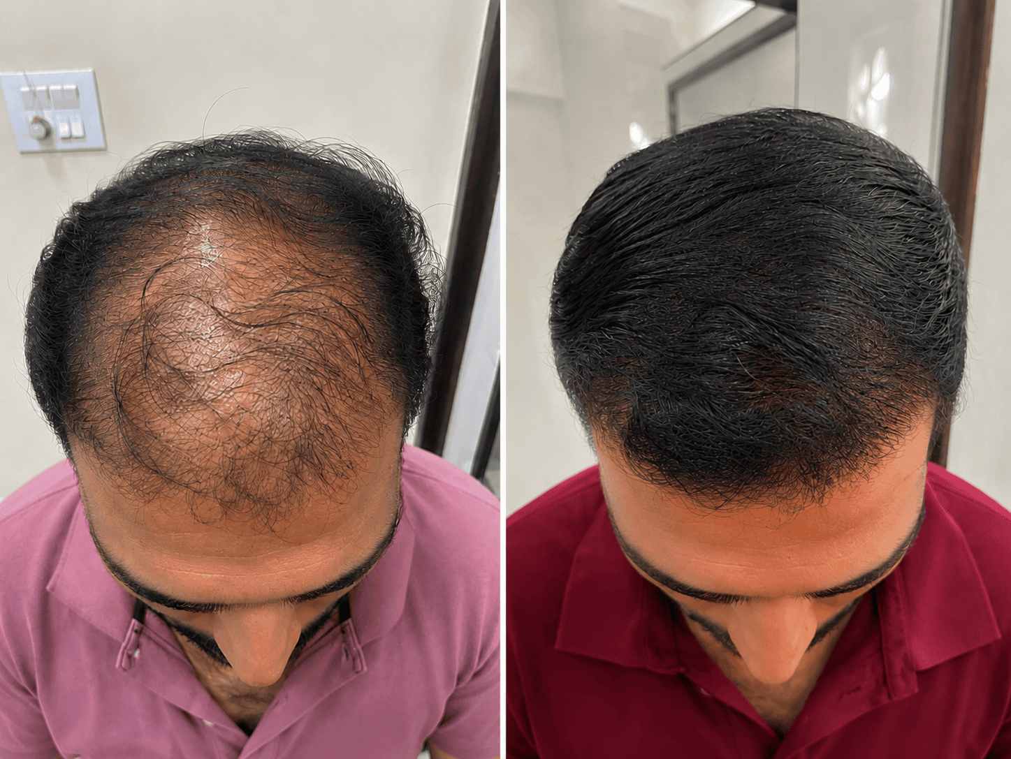 Before and after hair transplant results in Jaipur