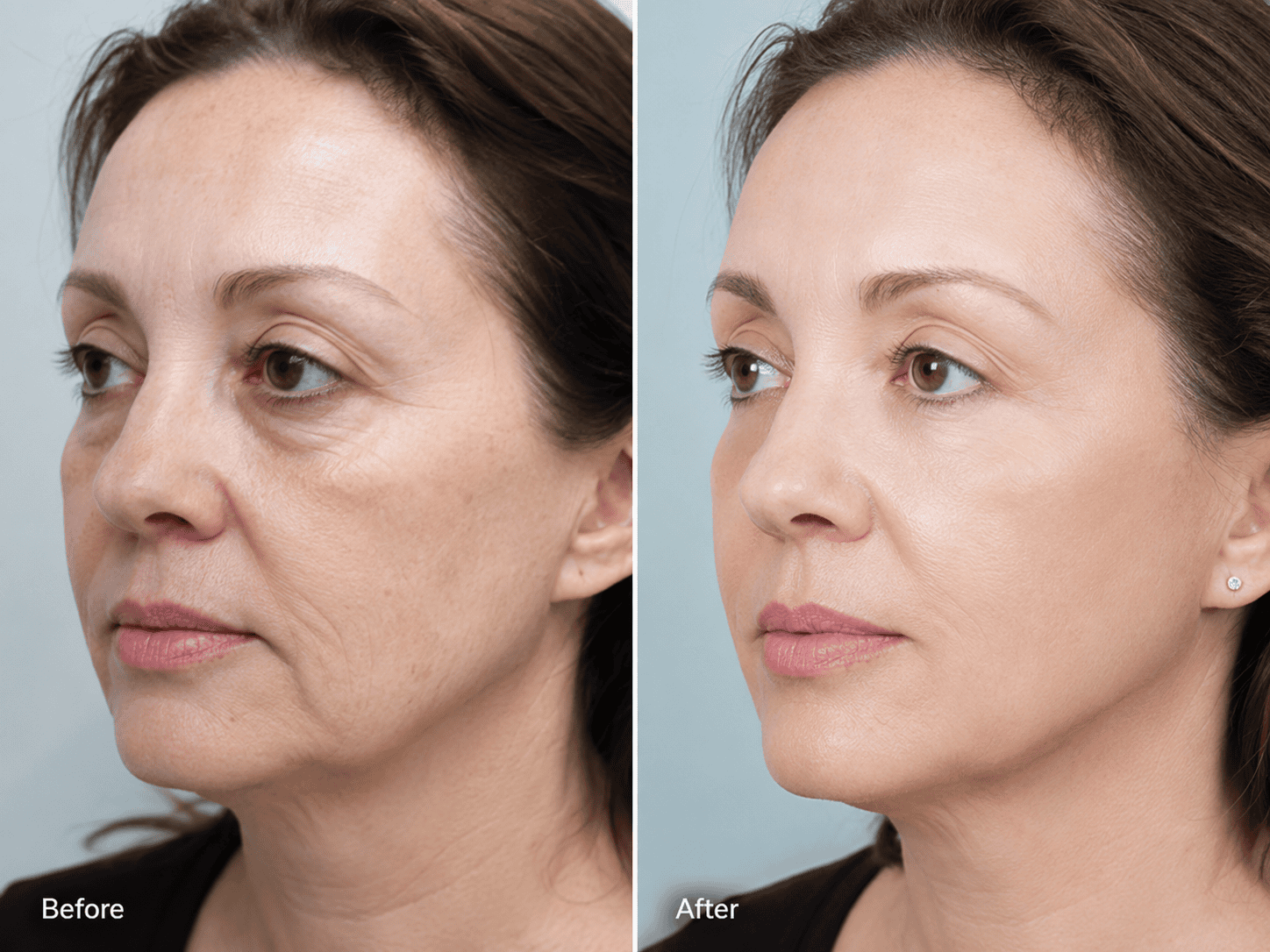 Before and after facelift surgery results by Dr. Saurabh Garg
