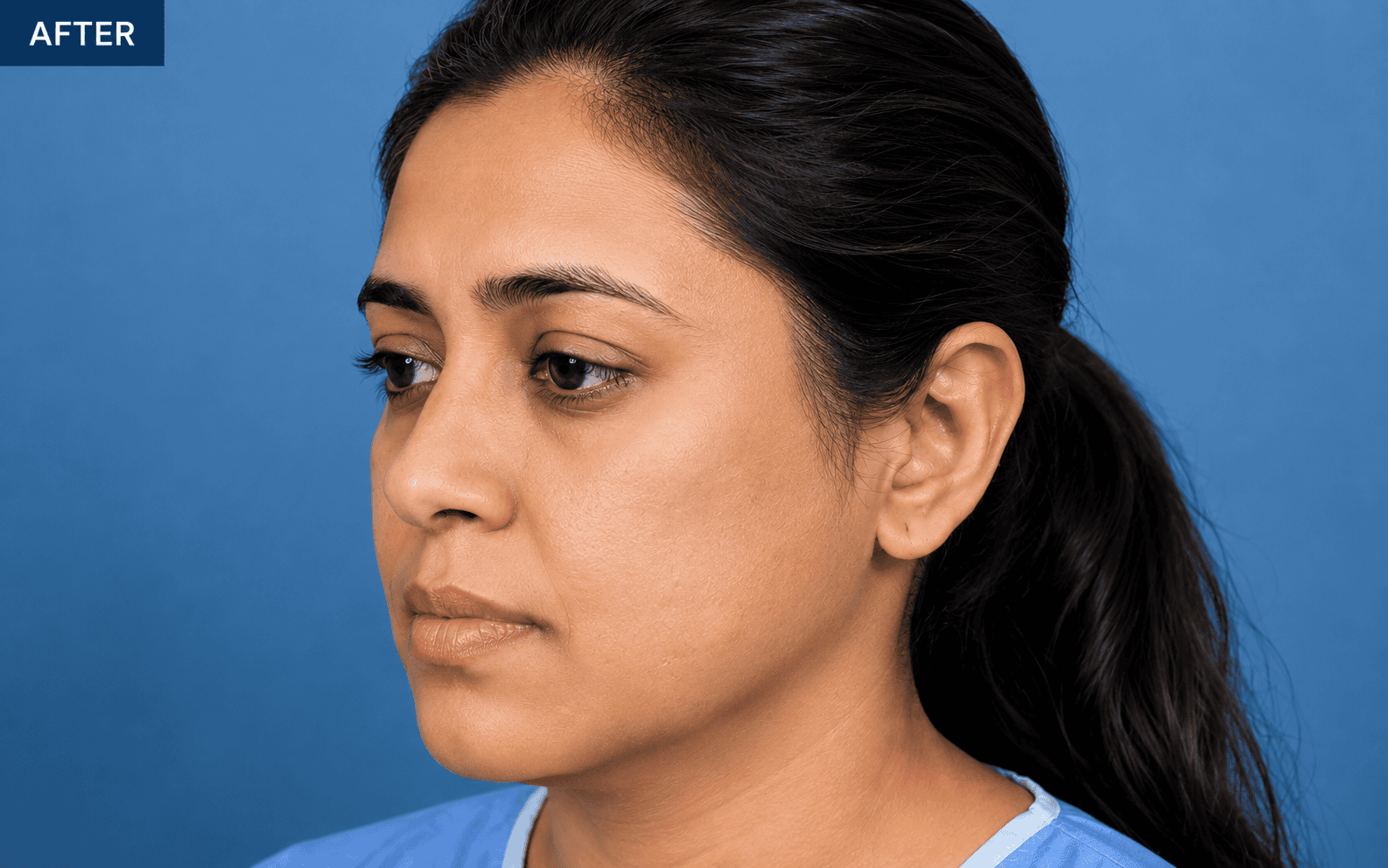 Before hair restoration treatment