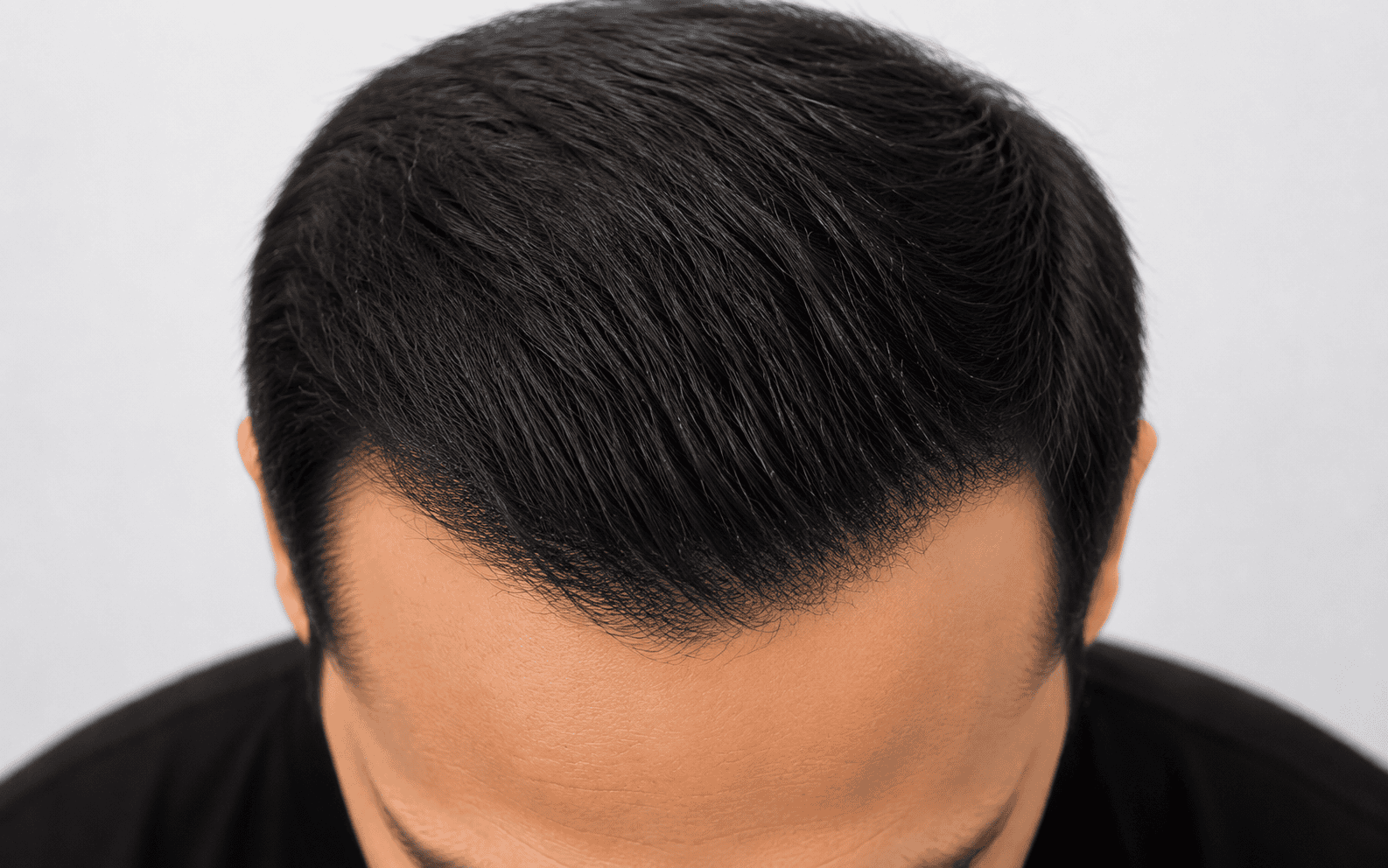 Before hair restoration treatment