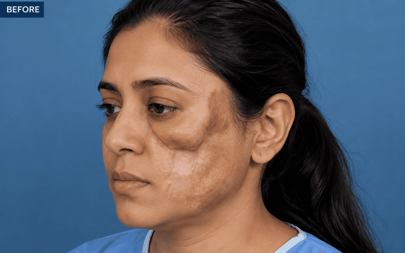 After hair restoration treatment