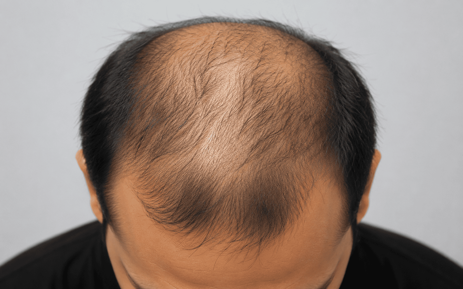 After hair restoration treatment