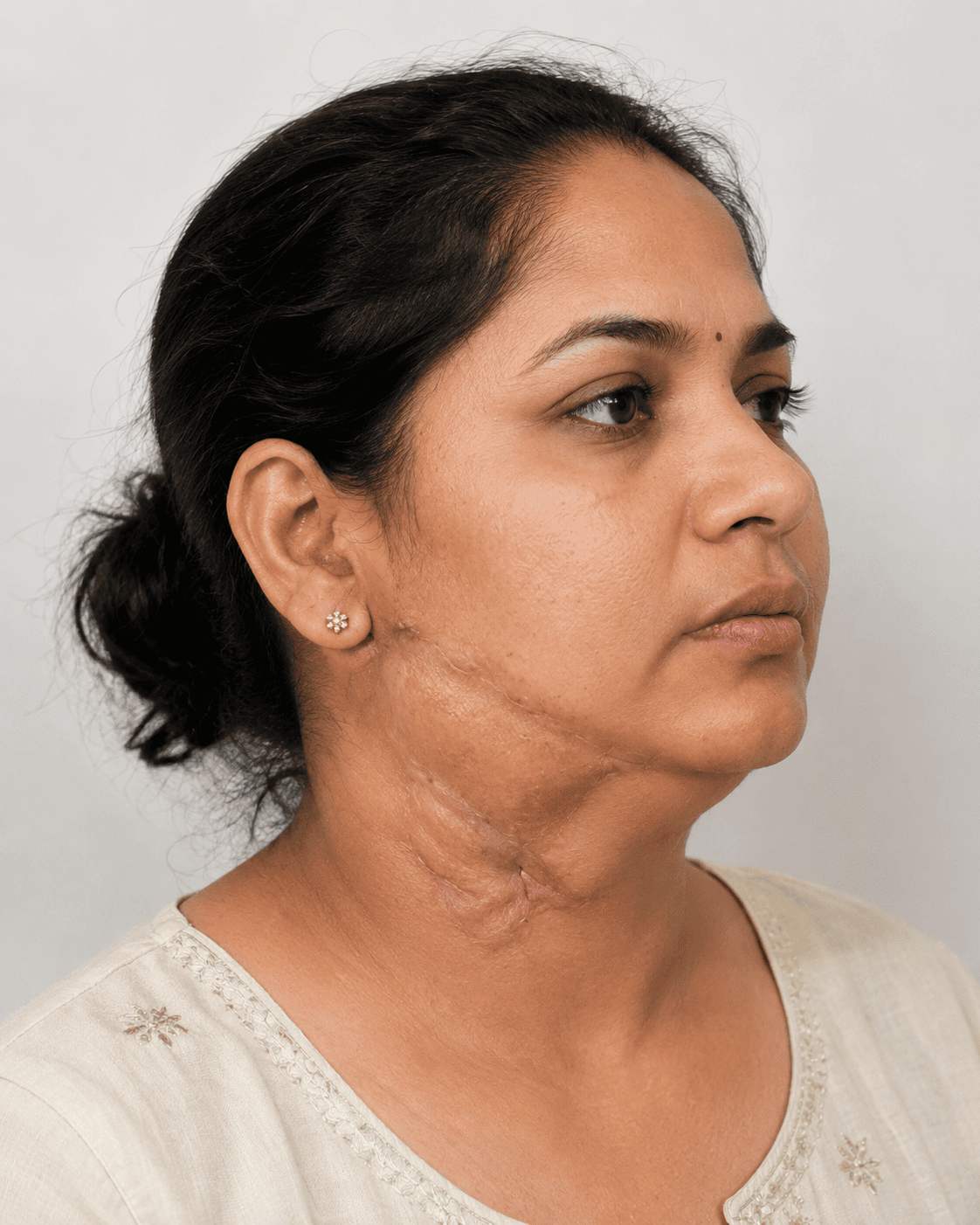 After hair restoration treatment